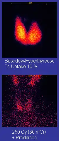 Upper image: two drop-like features merged at their bottoms; they have a yellow centre and a red rim on a black background. Caption: Graves' Disease Tc-Uptake 16%. Lower image: red dots on black background. Caption: 250 Gy (30mCi) + Prednison.