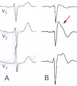 Normal electrocardiograms compared to electrocardiograms of people with Brugada Syndrome