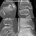 剝脫性骨軟骨炎患者的距骨（talus）內上側電腦斷層掃描影像（CT）以及膝關節X光（英语：）影像。