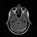 MRI image showing deviated septum