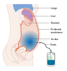 Diagram showing ascites being drained