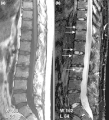 乾癬關節炎患者的腰部和胸部脊椎下半段的（a）T1 加權和（b）Short tau inversion recovery (STIR) 核磁共振成像。在數節脊椎（箭頭）都可見到活動性發炎。特別是在 L1/L2 處的前側脊椎炎，及 L3 的脊椎上層終板的發炎性安德森病兆（Andersson lesion）。