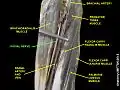 Radial nerve